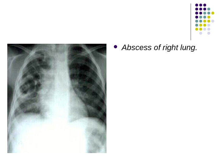  Abscess of right lung.  