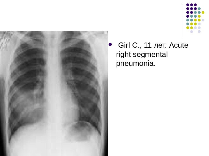   Girl С. , 11 лет.  Acute right segmental pneumonia.  