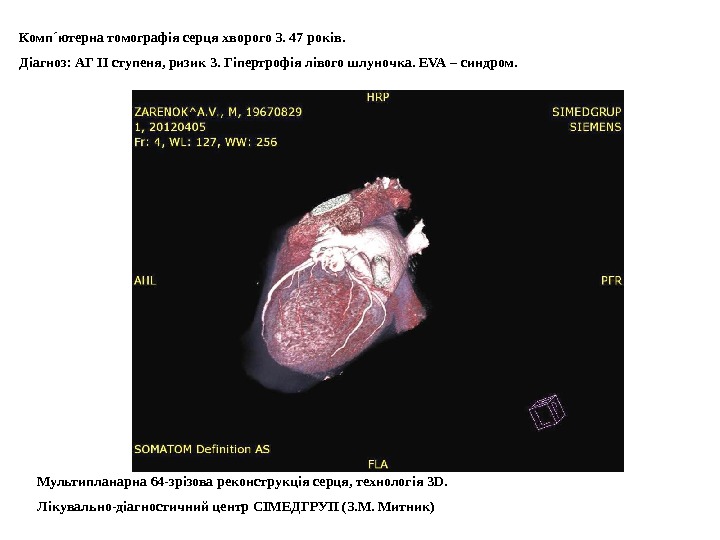 Комп ´ ютерна томографія серця хворого З. 47 років.  Діагноз: АГ ІІ ступеня, ризик 3.