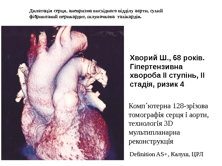 Дилатація серця, аневризма висхідного відділу аорти, сухий фібринозний перикардит, шлуночкова тахікардія. Комп ´ ютерна 128-зрізова томографія