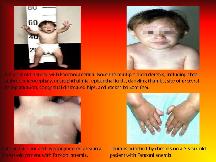 A 3 -year-old patient with Fanconi anemia. Note the multiple birth defects, including short stature, microcephaly,