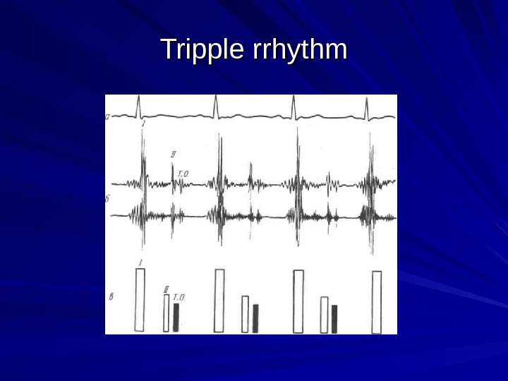  Tripple rrhythm 