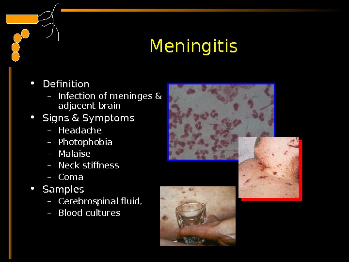  Meningitis • Definition – Infection of meninges & adjacent brain  • Signs & Symptoms