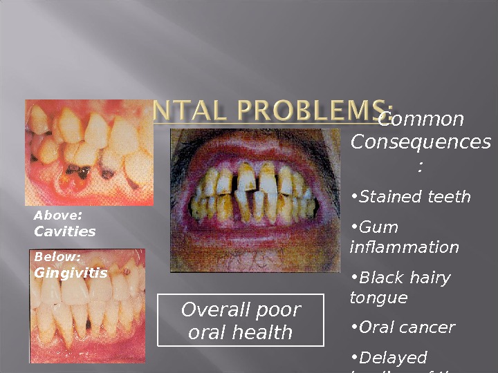 Above :  Cavities Below:  Gingivitis Overall poor oral health Common Consequences :  •