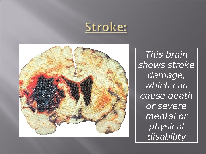 This brain shows stroke damage,  which can cause death or severe mental or physical disability