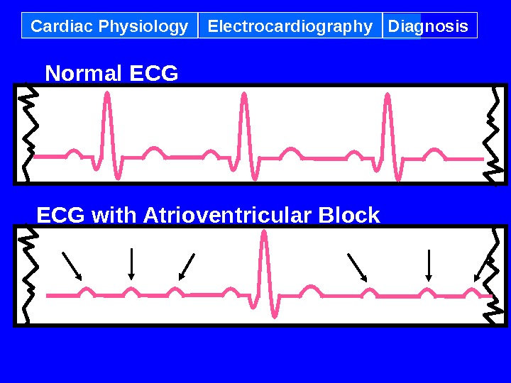 Cardiac Physiology Electrocardiography Diagnosis ECG with Atrioventricular Block Normal ECG 