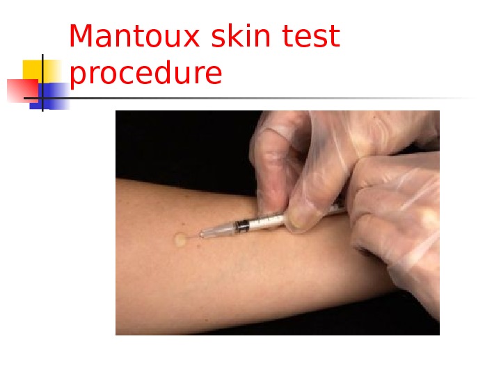 Mantoux skin test procedure 