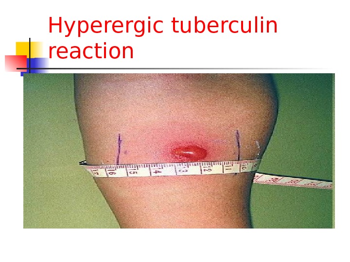 Hyperergic tuberculin reaction 