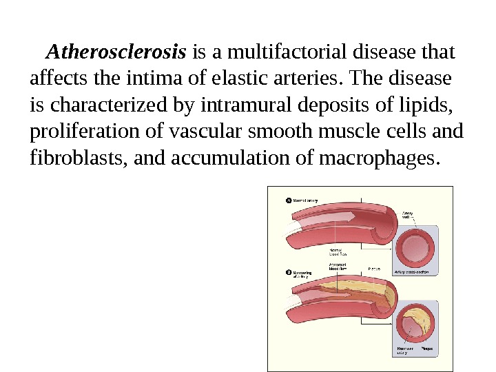   Atherosclerosis is a multifactorial disease that affects the intima of elastic arteries. The disease