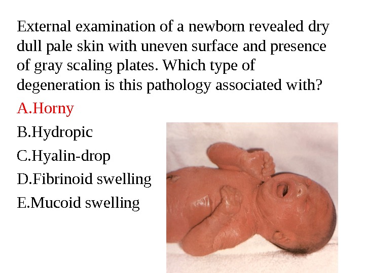 External examination of a newborn revealed dry dull pale skin with uneven surface and presence of