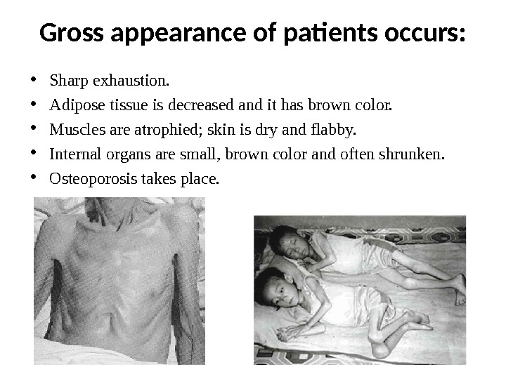 Gross appearance of patients occurs:  • Sharp exhaustion.  • Adipose tissue is decreased and