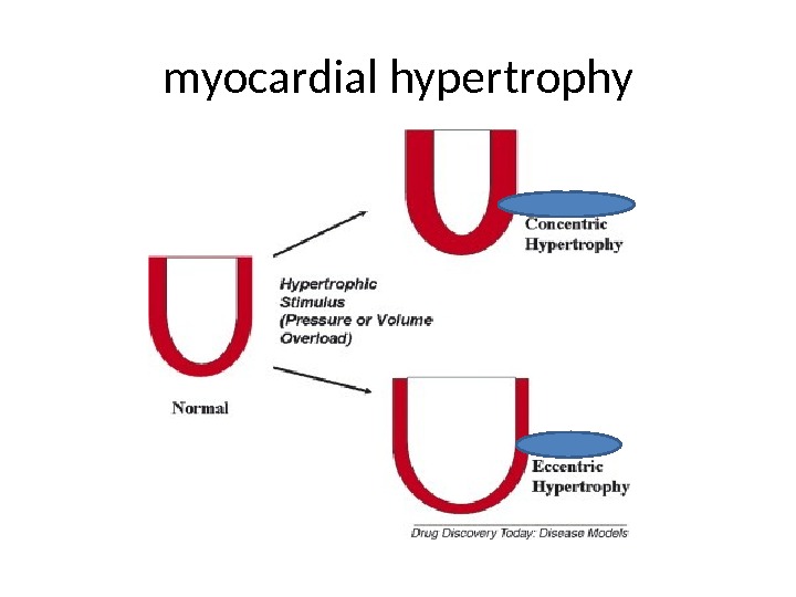 myocardial hypertrophy 