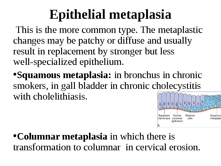 Epithelial metaplasia  This is the more common type. The metaplastic changes may be patchy or