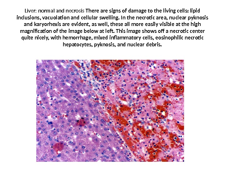Liver: normal and necrosis There are signs of damage to the living cells: lipid inclusions, vacuolation
