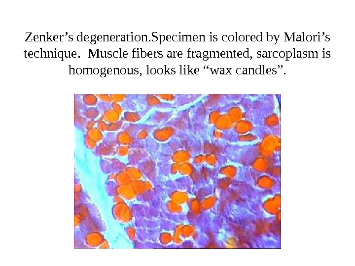 Zenker’s degeneration. Specimen is colored by Malori’s technique.  Muscle fibers are fragmented, sarcoplasm is homogenous,