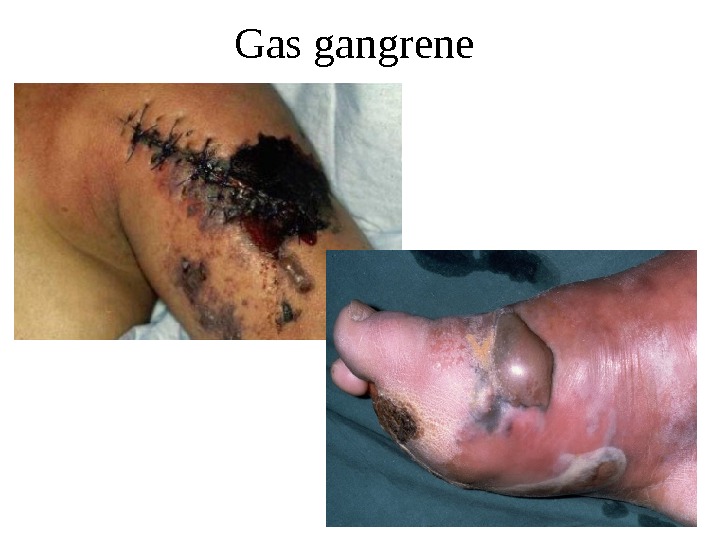 Gas gangrene 