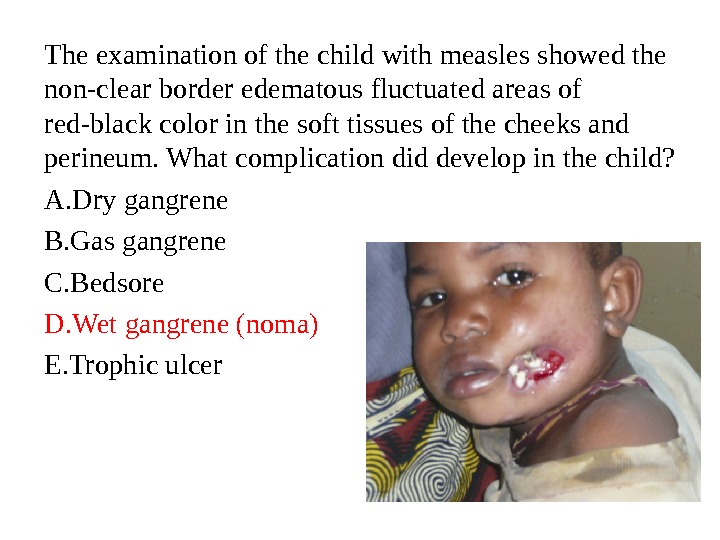 The examination of the child with measles showed the non-clear border edematous fluctuated areas of red-black