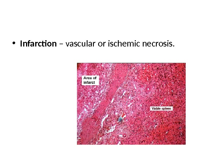  • Infarction – vascular or ischemic necrosis. 