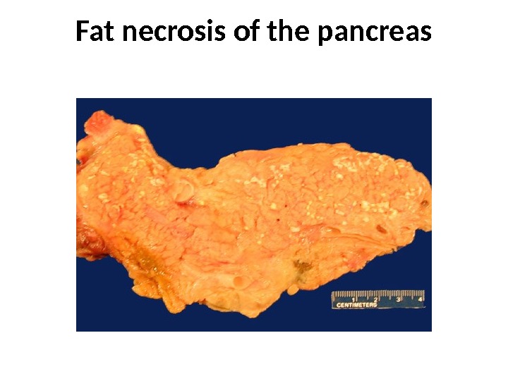 Fat necrosis of the pancreas 