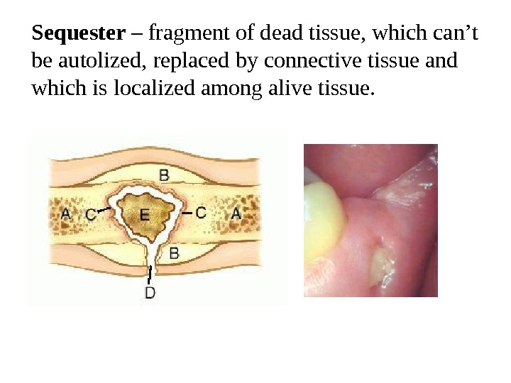 Sequester – fragment of dead tissue, which can’t be autolized, replaced by connective tissue and which