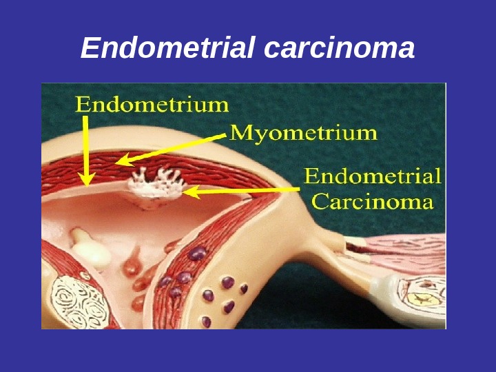 Endometrial carcinoma 