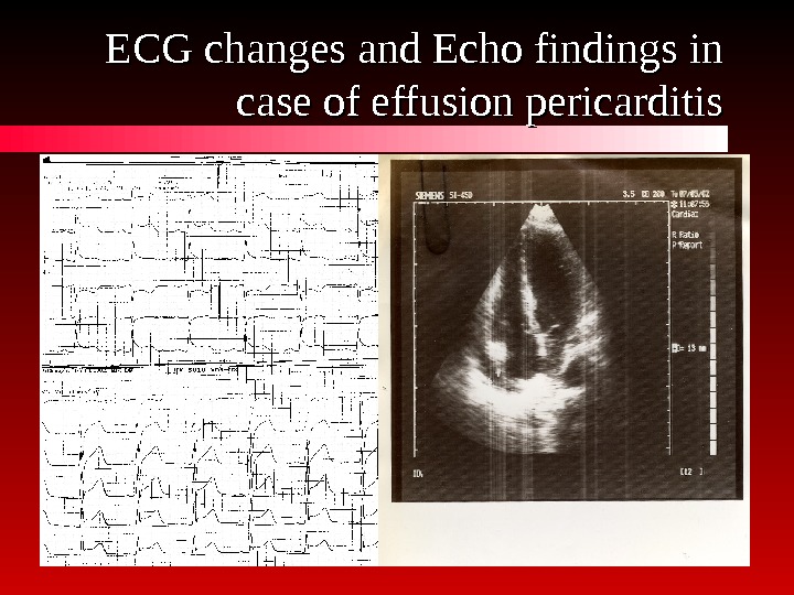   ECG changes and Echo findings in case of effusion pericarditis 