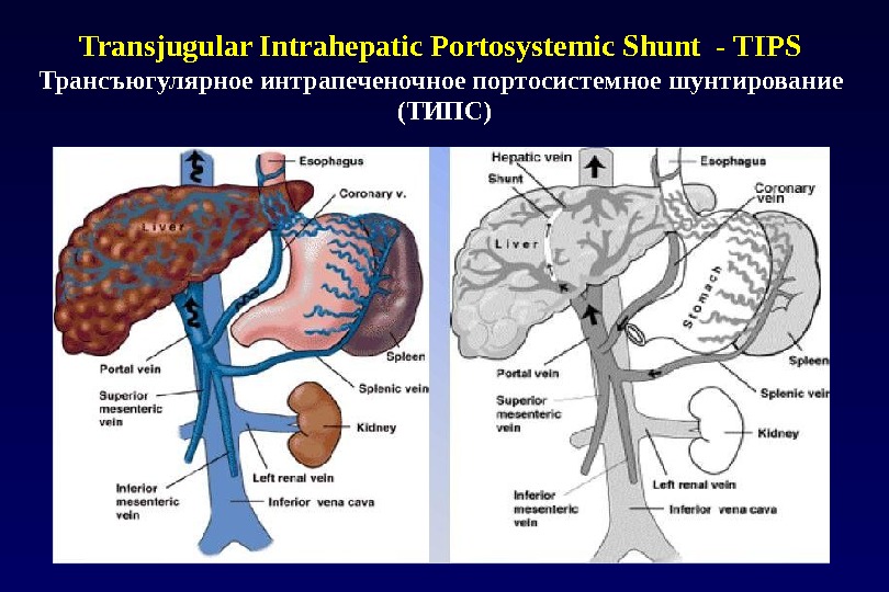 Transjugular Intrahepatic Portosystemiс Shunt - TIPS Трансъюгулярное интрапеченочное портосистемное шунтирование  (ТИПС) 