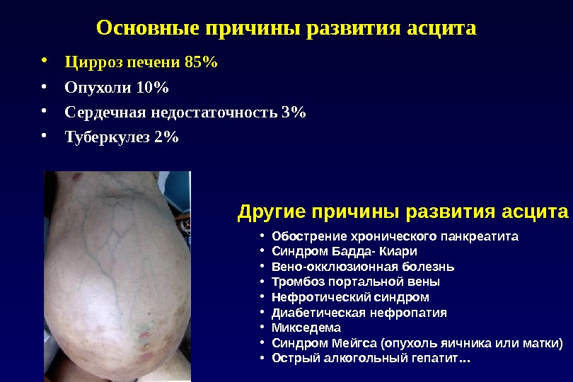 Основные причины развития асцита •  Цирроз печени 85% •  Опухоли 10% •  Сердечная