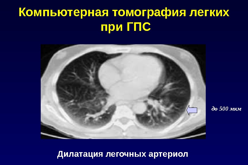 Компьютерная томография легких  при ГПС Дилатация легочных артериол до 500 мкм 