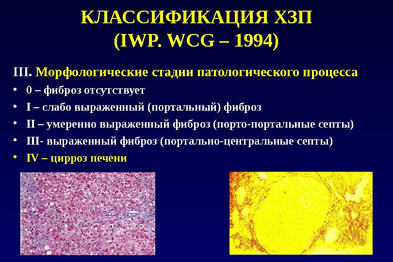 КЛАССИФИКАЦИЯ  ХЗП (IWP. CG – 1994) III.  Морфологические стадии патологического процесса • 0 –