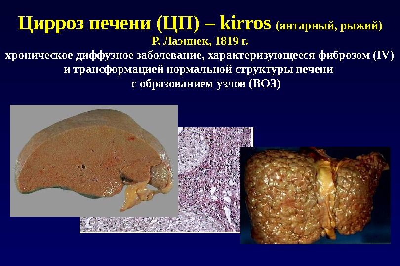 Цирроз печени (ЦП) – kirros (янтарный, рыжий)  Р. Лаэннек, 1819 г.  хроническое диффузное заболевание,