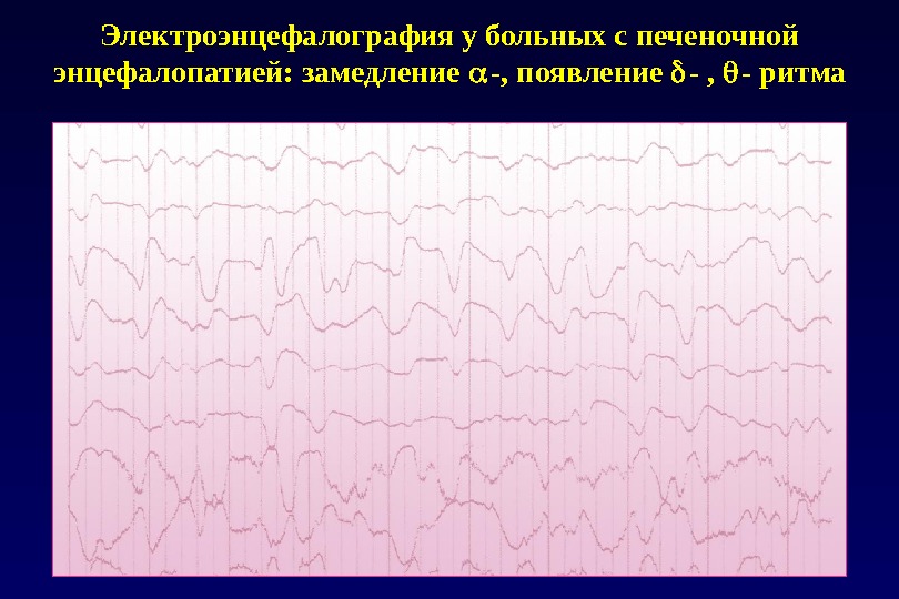 Электроэнцефалография у больных с печеночной энцефалопатией: замедление  -, появление  - ,  - ритма