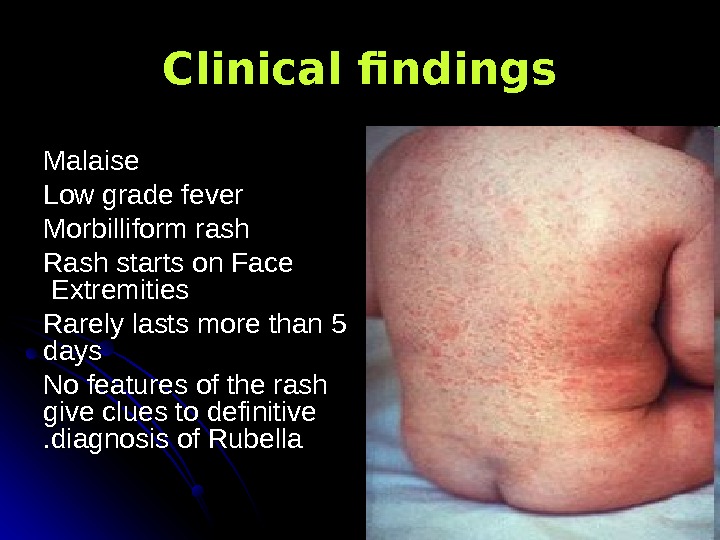   Clinical findings Malaise Low grade fever Morbilliform rash Rash starts on Face Extremities 