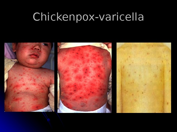   Chickenpox-varicella 