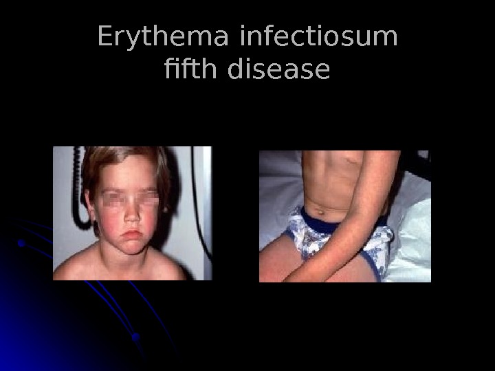   Erythema infectiosum fifth disease 