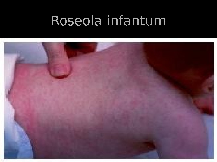   Roseola infantum 