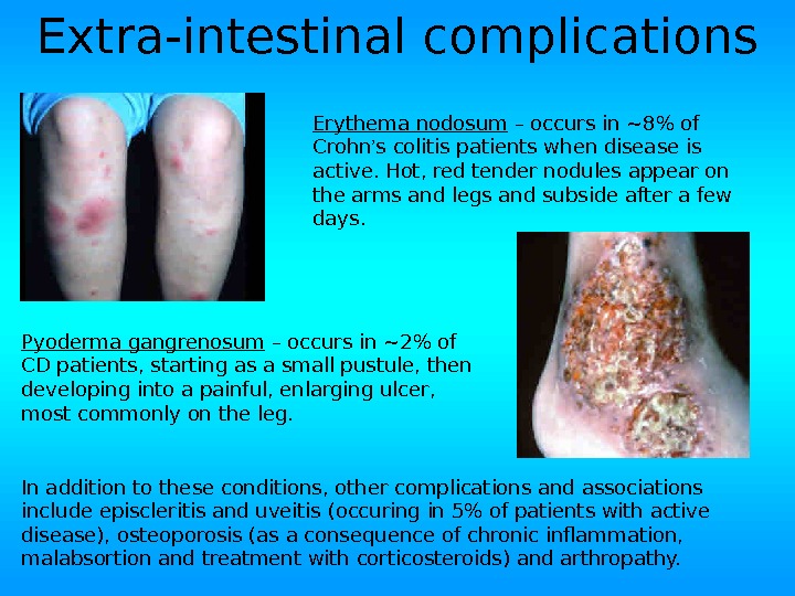 Extra-intestinal complications Pyoderma gangrenosum – occurs in ~2 of CD patients, starting as a small pustule,
