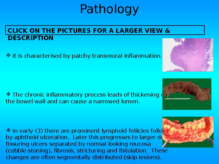 Pathology  It is characterised by patchy transmural inflammation. The chronic inflammatory process leads of thickening