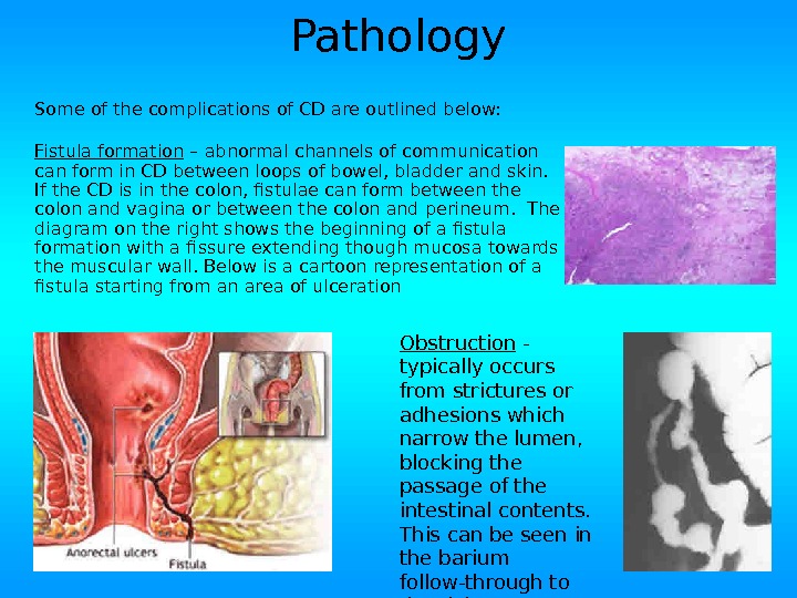 Pathology Some of the complications of CD are outlined below: Fistula formation – abnormal channels of