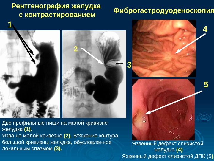   Рентгенография желудка  с контрастированием Фиброгастродуоденоскопия Язвенный дефект слизистой  желудка (4) Язвенный дефект