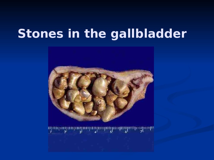 Stones in the gallbladder 