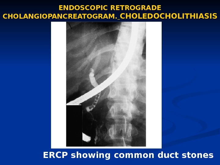 ENDOSCOPIC RETROGRADE CHOLANGIOPANCREATOGRAM. CHOLEDOCHOLITHIASIS ERCP showing common duct stones 