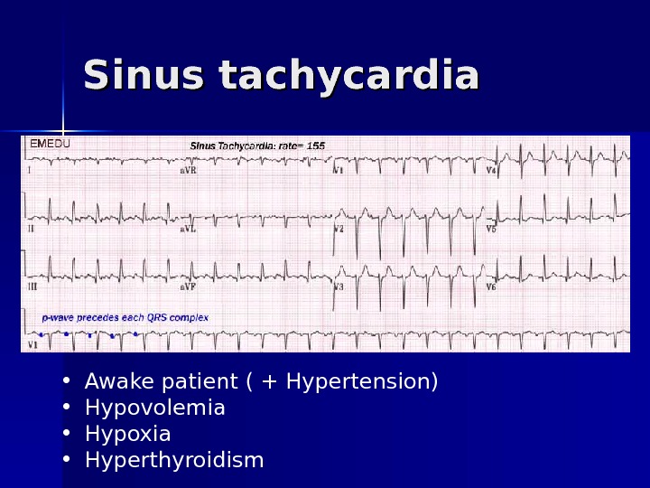 Sinus tachycardia • Awake patient ( + Hypertension) • Hypovolemia • Hypoxia • Hyperthyroidism 