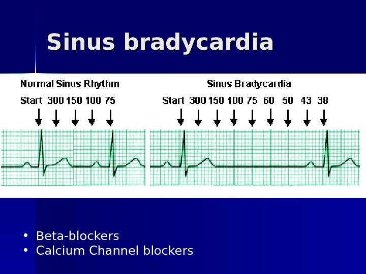 Sinus bradycardia • Beta-blockers • Calcium Channel blockers 