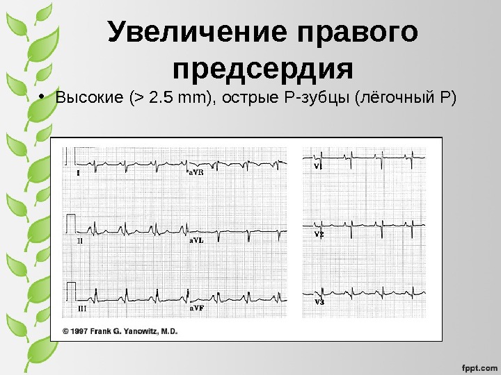 Интервал PQ (PR) Период распространения возбуждения по всей проводящей системе сердца. Норма – от 0, 12