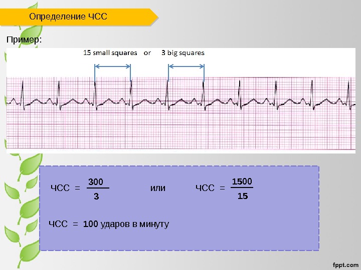 Sinus Arrhythmia Rate: Usually normal (60– 100 bpm);  frequently increases with inspiration and decreases with