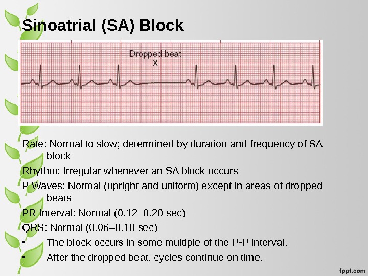 Sinoatrial (SA) Block Rate: Normal to slow; determined by duration and frequency of SA block Rhythm: