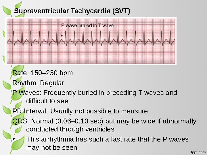 Supraventricular Tachycardia (SVT) Rate: 150– 250 bpm Rhythm: Regular P Waves: Frequently buried in preceding T