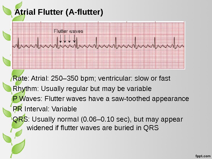 Atrial Flutter (A-flutter) Rate: Atrial: 250– 350 bpm; ventricular: slow or fast Rhythm: Usually regular but