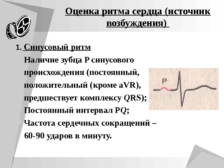 Оценка ритма сердца (источник возбуждения) 1.  Синусовый ритм Наличие зубца P синусового  происхождения (постоянный,